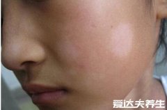 白斑最初期的图片,光滑不脱屑向周围扩散