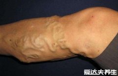早期小腿静脉曲张图片症状，突出皮肤的血