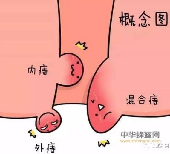 肛门处长了一个肉疙瘩是怎么回事,可能是比痔疮更严重的X病