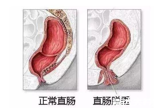 肛门处长了一个肉疙瘩是怎么回事,可能是比痔疮更严重的X病
