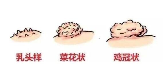 肛门处长了一个肉疙瘩是怎么回事,可能是比痔疮更严重的X病