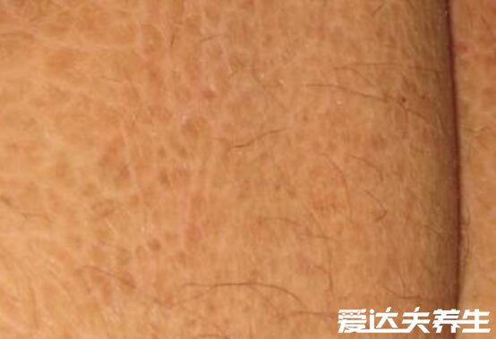 轻微鱼鳞病图片及症状,皮肤为鱼鳞状易干燥缺水