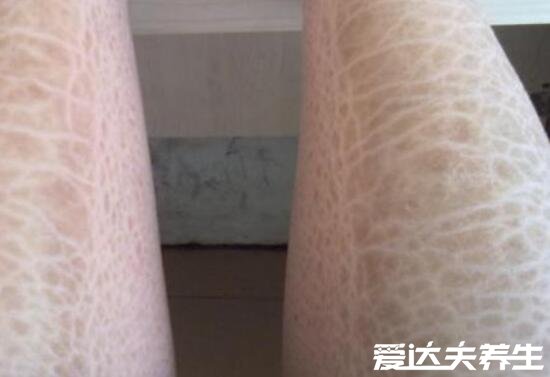 轻微鱼鳞病图片及症状,皮肤为鱼鳞状易干燥缺水