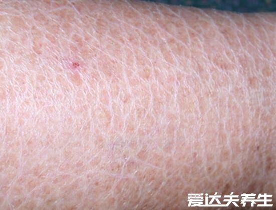 轻微鱼鳞病图片及症状,皮肤为鱼鳞状易干燥缺水