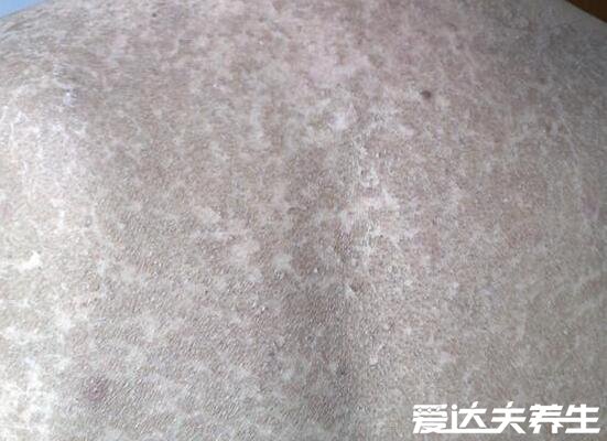 轻微鱼鳞病图片及症状,皮肤为鱼鳞状易干燥缺水