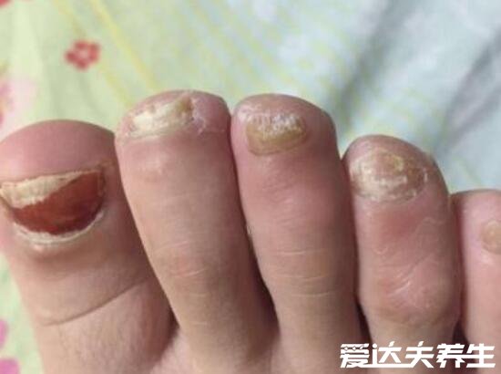 灰指甲初期症状图片及治疗方法,有两大症状需及时治疗(慎入)
