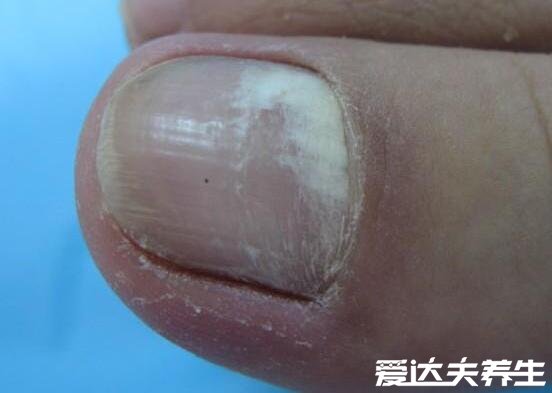 灰指甲初期症状图片及治疗方法,有两大症状需及时治疗(慎入)
