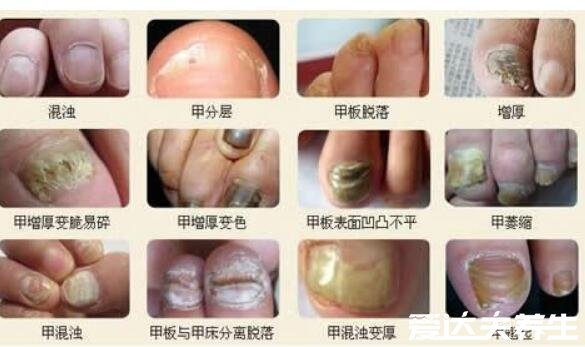 灰指甲初期症状图片及治疗方法,有两大症状需及时治疗(慎入)