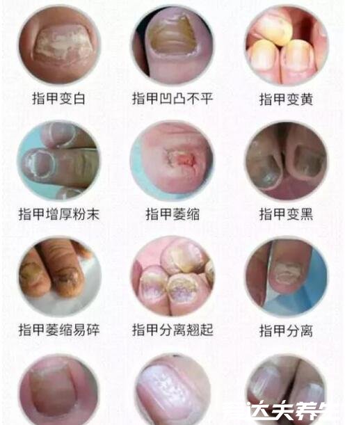 灰指甲初期症状图片及治疗方法,有两大症状需及时治疗(慎入)