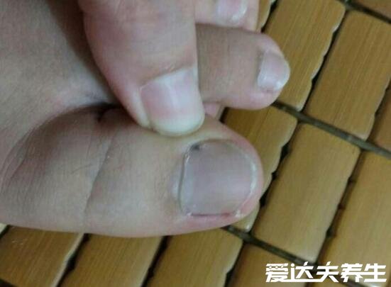灰指甲初期症状图片及治疗方法,有两大症状需及时治疗(慎入)