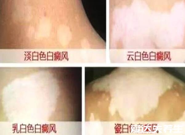 白癜风初期症状图片,光滑无异样的白斑会向边缘扩散