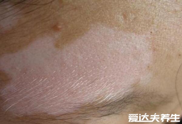 白癜风初期症状图片,光滑无异样的白斑会向边缘扩散