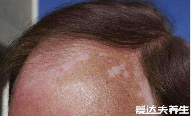 白癜风初期症状图片,光滑无异样的白斑会向边缘扩散