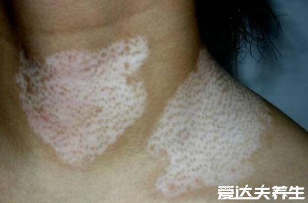 白癜风初期症状图片,光滑无异样的白斑会向边缘扩散