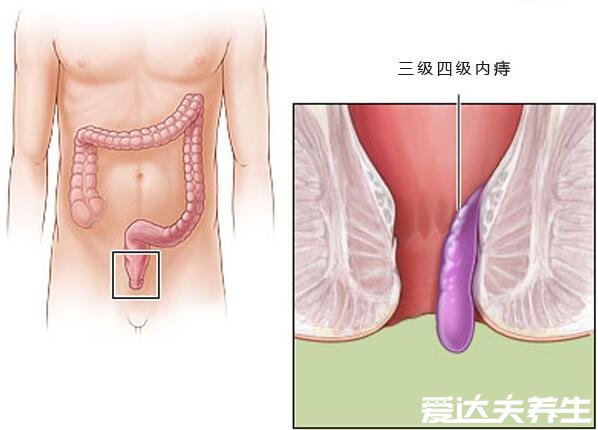 不同程度的内痔疮图片,一般不严重但严重的必须手术切除