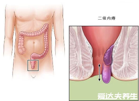 不同程度的内痔疮图片,一般不严重但严重的必须手术切除
