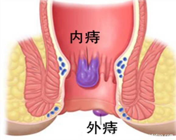 不同程度的内痔疮图片,一般不严重但严重的必须手术切除