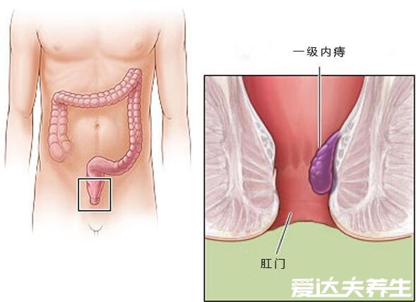 不同程度的内痔疮图片,一般不严重但严重的必须手术切除
