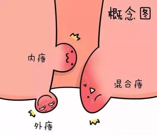 不同程度的内痔疮图片,一般不严重但严重的必须手术切除