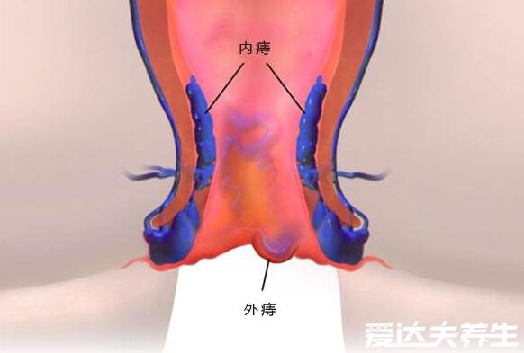 真实的外痔疮图片,4种类型外痔的病因及治疗方法