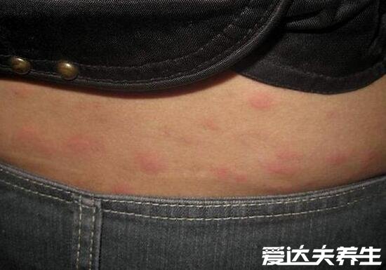 身上起红疙瘩很痒图片及原因,可能是湿疹引起的(四大原因)