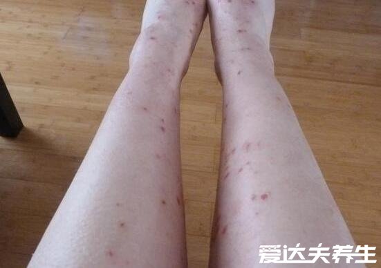 身上起红疙瘩很痒图片及原因,可能是湿疹引起的(四大原因)