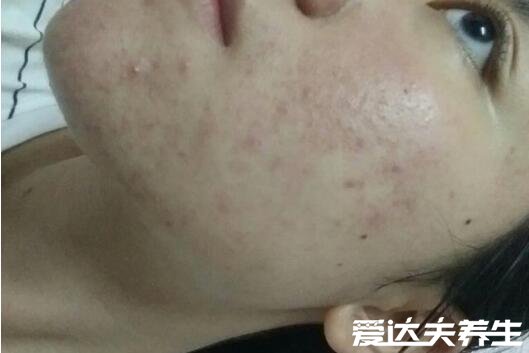身上起红疙瘩很痒图片及原因,可能是湿疹引起的(四大原因)