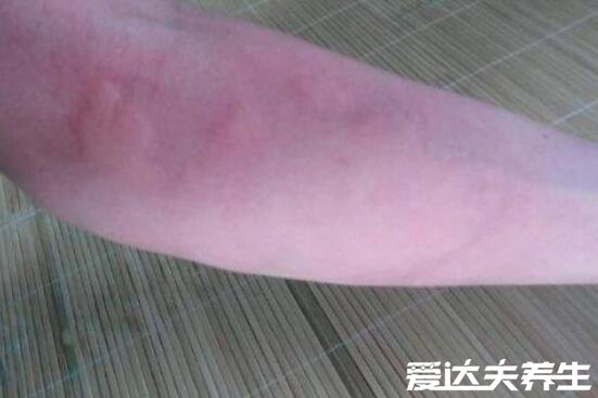 身上起红疙瘩很痒图片及原因,可能是湿疹引起的(四大原因)