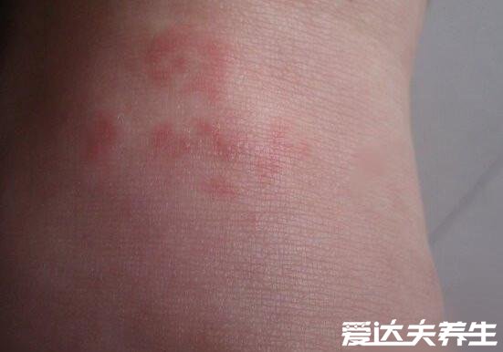 艾滋病身上起疙瘩图片,如普通皮疹会皮肤出现溃烂