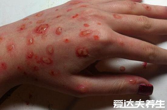 艾滋病身上起疙瘩图片,如普通皮疹会皮肤出现溃烂