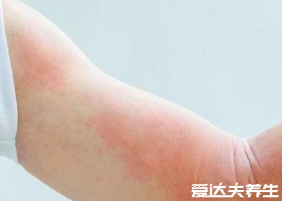 艾滋病身上起疙瘩图片,如普通皮疹会皮肤出现溃烂