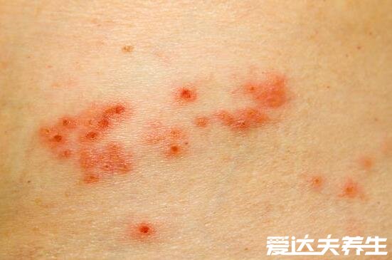 艾滋病身上起疙瘩图片,如普通皮疹会皮肤出现溃烂