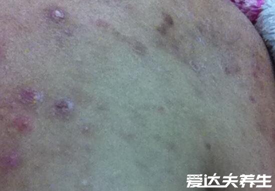 艾滋病身上起疙瘩图片,如普通皮疹会皮肤出现溃烂