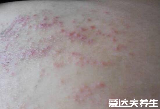 艾滋病身上起疙瘩图片,如普通皮疹会皮肤出现溃烂