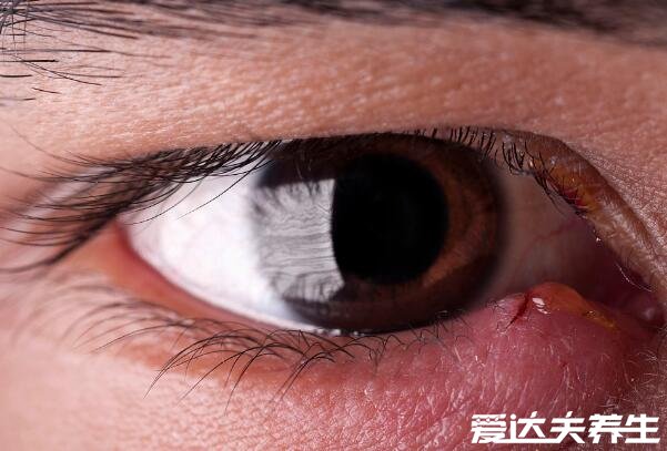 麦粒肿早期图片,眼睛长针眼的早期症状