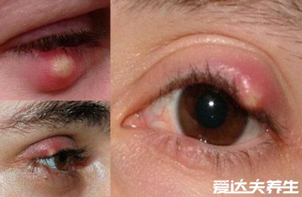 麦粒肿早期图片,眼睛长针眼的早期症状