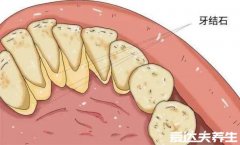 牙结石可以自己抠掉吗,不要自己扣定期洗