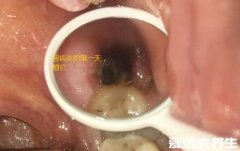 智齿拔牙后窟窿恢复图，4个过程3个月时间可