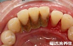 牙结石图片及症状是什么样,牙龈附近有黄