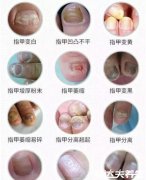 灰指甲初期症状图片及治疗方法,有两大症
