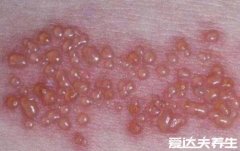 皮肤病的种类图片大全,六大类皮肤病图片