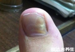 轻微灰指甲图片症状及治疗方法,为指甲轻