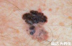 早期皮肤癌图片和症状,最严重的是黑色素