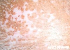 皮肤病的种类图片大全及症状,主要分为两