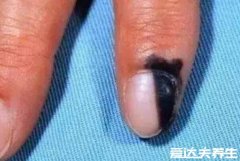指甲黑色素瘤图片,指甲出现黑线和甲母痣
