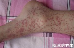 紫癜的早期症状图片，警惕除了皮肤长红点