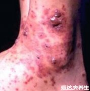 紫癜初期的图片及症状，会出现对称性斑疹