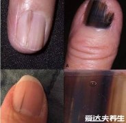 甲下黑色素瘤图片及症状,和甲下出血相似