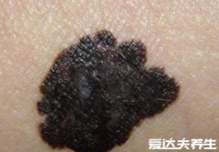 黑色素瘤早期症状图片,和普通黑痣相似但