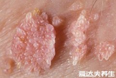 尖湿锐尤典型图片，尖锐湿疣早期症状真假